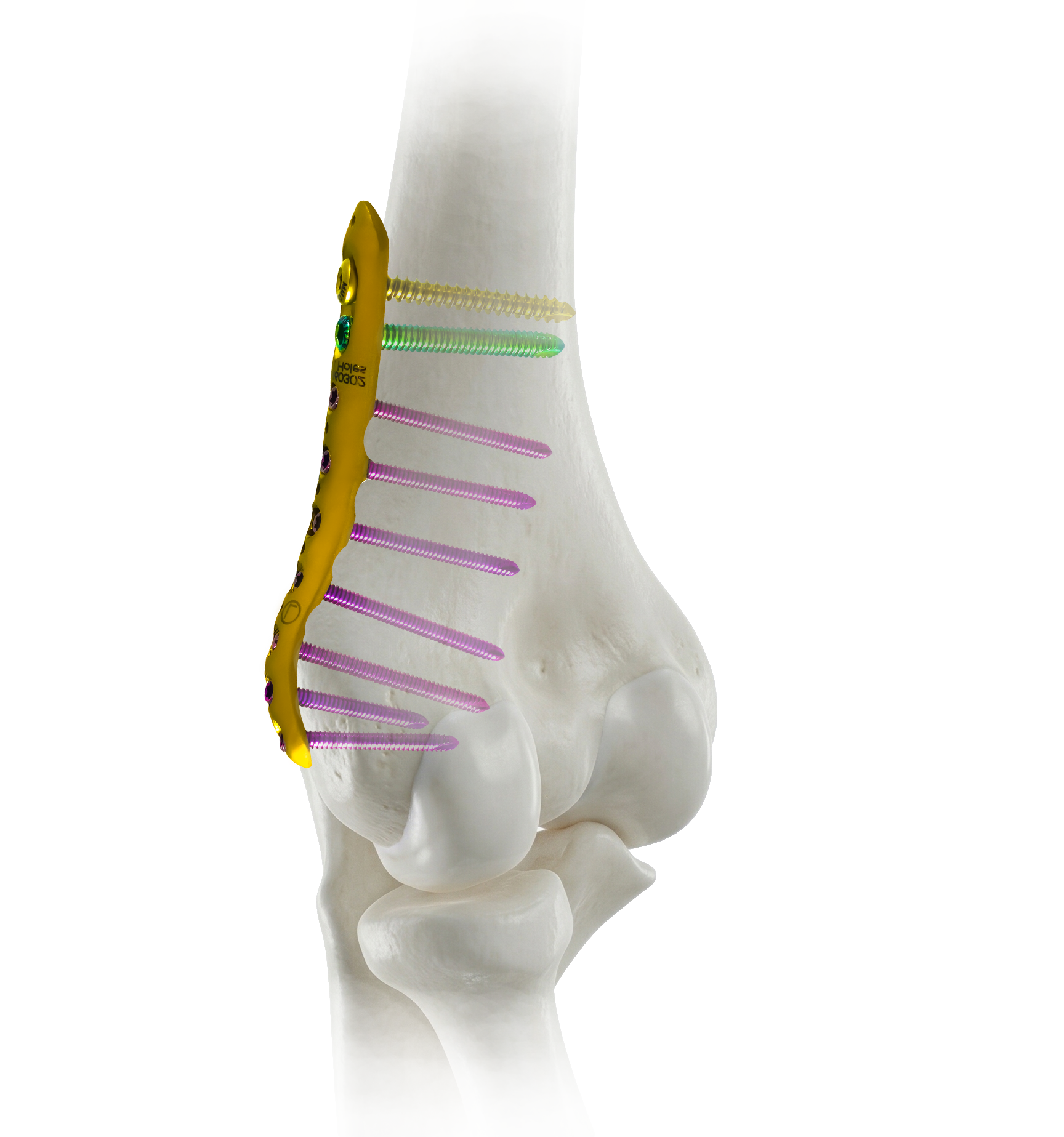 Fractured radius plate visual